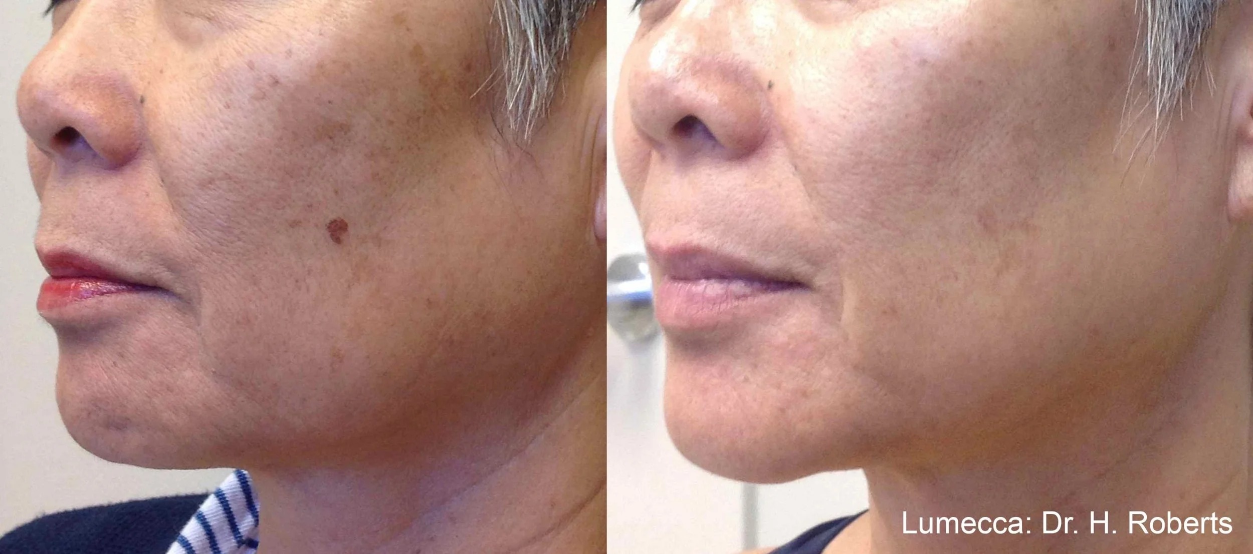Lumecca before and after
